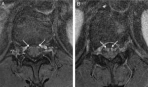 Fat-suppressed T1-weighted axial MRI showing enhancement of the anterior nerve roots in D12 and L1 and in the conus medullaris.