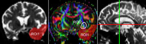 Coronal view of the ROI locations for the left UNC; position of the coronal slice (green line) within a sagittal plane.