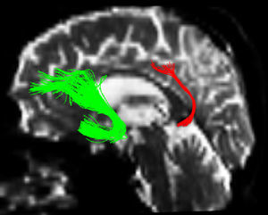 Left-sided uncinate fasciculus (green) and posterior cingulate fasciculus (red).