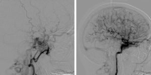 Left: Right external carotid artery angiogram, lateral projection, with blood supply from the internal maxillary artery to the cavernous sinus. Right: Lateral projection angiogram of the right internal carotid artery showing blood supply to the cavernous sinus. Both images show the co-presence of reflux to the right ophthalmic vein and facial veins, with extensive participation by right-sided cerebral cortical veins.