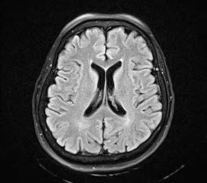 Gadolinium-enhanced FLAIR (fluid-attenuated inversion-recovery) magnetic resonance image of the brain: microangiopathic leukoencephalopathy.