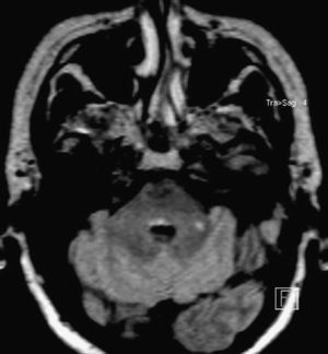 Brain MRI scan with axial 3D FLAIR sequence.