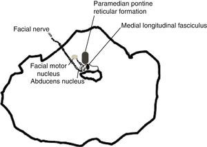 Schema illustrating the lesion observed in brain MRI.
