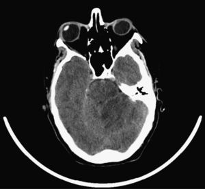 Head CT. Oedema and small fourth ventricle: signs of intracranial hypertension.
