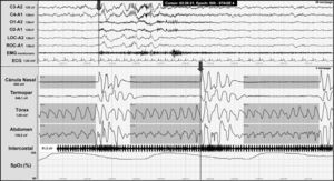 Night-time polysomnography record showing obstructive apnoea (shown in grey bands) in a patient with Chiari malformation type 1. The grey line at the end of the respiratory event (arrow) indicates the onset of the cortical microarousal. This can be viewed in the EEG channel results and in the decrease in oxygen saturation.