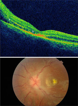 Above: Optical coherence tomography (OCT) displaying papilloedema with extravasation into the macula (a) and photoreceptor damage (b). Below: View of fundus showing papilloedema and macular star pattern.