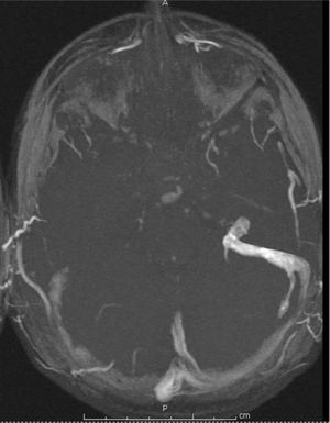 MR angiography: venous thrombosis of the right transverse/sigmoid sinus.
