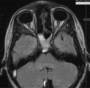 Brain MRI: hyperintensity in the left optic disc: papilloedema.