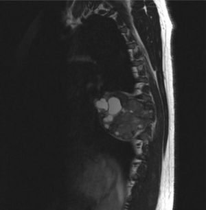 Spine MRI in sagittal T2-weighted sequences: homogeneous, multicystic lesion with no contrast uptake, extending from the posterior arch of the left seventh rib to the chest and spinal canal and compressing the spine at that level.