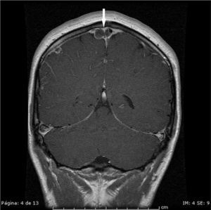 Brain MRI. Coronal T1-weighted contrast-enhanced image. Superior sagittal sinus partially occupied by a bilobed thrombus (arrow).