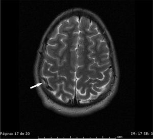 Brain MRI. Axial T2-weighted slice. Dilation of a cortical vein secondary to sinus thrombosis (arrow).