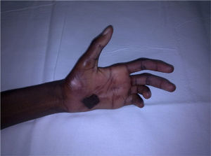 Left hand displaying ulnar claw and burn on palm.