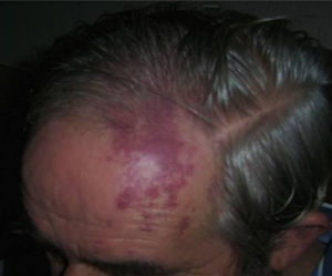 Flat angioma in the territory of the ophthalmic branch of the fifth cranial nerve.