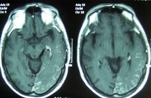 T1-weighted MRI scan with gadolinium contrast showing leptomeningeal vascular malformation affecting the left occipital, temporal and parietal lobes.