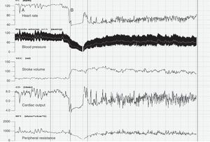 Non-invasive haemodynamic study with the Task Force® Monitor during the tilt table test. (A) Postural tachycardia. (B) Syncope with initial cardioinhibitory response and vasodepressor response.