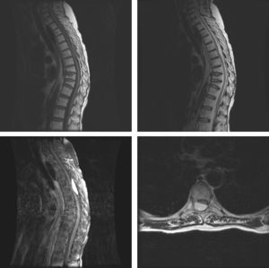Upper left: sagittal section, T1-weighted MRI image showing isointense epidural lesion affecting various levels. Osteoporotic fractures of 3 vertebral bodies. Centre: hypointense lesion on T2-weighted MRI image (sagittal section). Lower left: MRI image confirms contrast uptake (sagittal section). Lower right: Axial section, T1-weighted MRI image with contrast uptake showing spinal compression caused by the cavernous angioma.