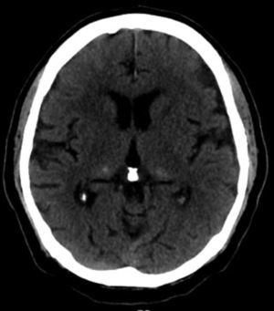 Brain CT. Hyperdensities can be seen in both pulvinar nuclei.
