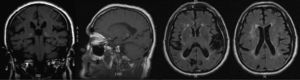 Brain MRI. Sagittal and coronal T1-weighted sequences; axial FLAIR sequence. T1 weighted sequence of hyperintensities in both pulvinar nuclei.