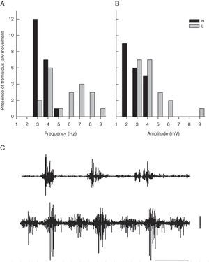 (A) Frequency (Hz) of EMG activity in the temporal muscle during tremulous jaw movement in the haloperidol group (H) and the electrolytic VLS lesion group (L). (B) Amplitude (mV) of EMG activity in the temporal muscle during tremulous jaw movement in the haloperidol group (H) and the electrolytic VLS lesion group (L). (C) One-second sample of EMG trace showing tremulous jaw movements in the haloperidol group (H), and electrolytic VLS lesion group (L). Horizontal calibration: 200ms. Vertical calibration: 1mV.