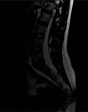 T2-weighted sagittal spinal MRI of the lumbosacral region. Image shows a rounded lesion 16mm in diameter in the distal region of the intradural spinal canal at the level of the S1 area, hyperintense in T2 with lower signal intensity in the centre. It is consistent with cysticercus cyst in the vesicular colloidal stage. There are no other signs of intra- or extramedullary lesions in other areas of the spinal column.
