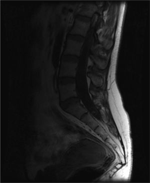 Sagittal spinal MRI of the lumbosacral region. Same lesion in T1 sequence, showing a capsule and a small elongated satellite nodule, consistent with the vesicular colloidal stage.