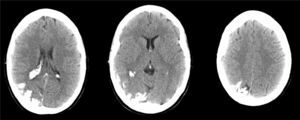 Cranial CT without contrast: cortical calcification and discrete atrophy of the right occipital lobe, and calcification and enlargement of the choroid plexus of the occipital horn of the right ventricle.