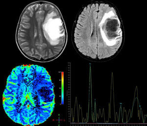 A 12-year-old girl with no relevant medical history presented acute vision loss in the right eye (RE) that was not treated. Four months later, she experienced aphasia and right hemiparesis. This figure shows some of the brain MR images that were ordered: above, axial T2-weighted images and axial Fluid Attenuation Inversion Recovery (FLAIR) images. We observe a right frontal lesion that is hyperintense in T2-weighted images and hypointense in T1-weighted images. FLAIR sequence shows adjacent vasogenic oedema and slight mass effect on the midline and ventricular system. Images suggesting vessel-like structures were obtained from the inside of the lesion. Below: brain perfusion image showing decreased enhancement and MRI spectroscopy that shows an elevated choline peak at 3.23ppm (indicative of gliolysis and remyelination processes), a decreased NAA peak at 2.05ppm (indicative of neuronal/axonal injury), and glutamate and glutamine peak of 2.4–2.5ppm. These findings were compatible with tumour-like demyelinating disease. Histopathological findings from the brain biopsy were consistent with FTDL. Doctors started a 5-day course of treatment with methylprednisolone, followed by one cycle of plasmapheresis. Clinical response was excellent. The patient completely regained her strength on the right side of the body and her ability to speak, but optic atrophy of the RE remained. After one year of follow-up, no relapses have been reported.