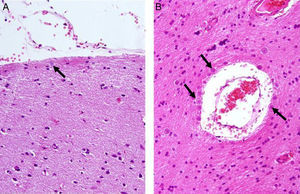 Presence of corpora amylacea (arrows) in the neocortex in patients with drug-resistant temporal lobe epilepsy. (A) Meningeal surface (grade 1). (B) Around a blood vessel, showing dilated perivascular space (white matter, grade 3). H&E ×400.