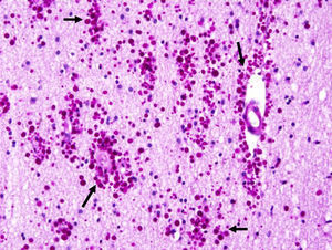 Marked accumulation of corpora amylacea (arrows) in the neocortex (parenchyma of the white matter and around blood vessels, grade 3) in a patient with drug-resistant temporal lobe epilepsy. PAS ×200.