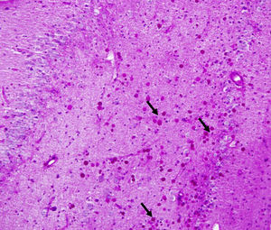Numerous corpora amylacea (arrows) in the hippocampus (field CA4 and granule cell layer, grade 3) in a patient with drug-resistant temporal lobe epilepsy. PAS ×400.
