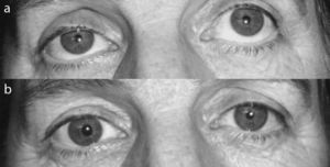 (a) Right palpebral ptosis. (b) Ptosis resolved after instillation of phenylephrine.