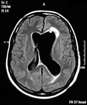 Ventricular dilation and periventricular hyperintensity in meningoventriculitis due to S. agalactiae. Axial cranial MRI, fluid-attenuated inversion recovery (FLAIR) sequence.
