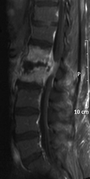L1-L2 spondylodiscitis due to S. agalactiae with epidural abscess and spinal cord compression. Sagittal spinal MRI, T1-weighted sequence after gadolinium injection.