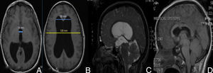 Presurgical imaging studies (A and B): T1-weighted brain MRI without contrast that revealed triventricular hydrocephalus. Evans index was 0.43 (B) and third ventricle diameter was >1.4cm (A). Presurgical study (C): T2-weighted MRI showing increased convexity of the corpus callosum, flattening of the midbrain, and stenosis of the aqueduct of Sylvius. Postsurgical studies (D): T1-weighted MRI without contrast that revealed decreased ventricular size, upward displacement of midbrain, and the endoscope path for the third ventriculostomy.