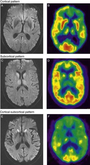 Cortical pattern. (A) Cortical hyperintensity in frontal-parietal-occipital regions of the left hemisphere in DWI sequences. (B) FDG-PET shows hypometabolism in the cortical-parietal, posterior cingulate, and dorsolateral frontal regions of the left hemisphere, as well as in the left basal ganglia and both thalamic hemispheres. Subcortical pattern. (C) Subcortical hyperintensity (basal ganglia and thalamus bilaterally) in DWI sequences. (D) FDG-PET scan shows hypometabolism in the left temporal cortical and subcortical regions (bilateral in thalamus). Cortical-subcortical pattern. (E) Bilateral symmetrical hyperintensity in frontal cortical and parietal regions; subcortical hyperintensity (caudate nucleus and putamen) in DWI sequences. (F) FDG-PET shows hypometabolism in both cortical areas (anterior association area and cingulate cortex) and subcortical areas (basal ganglia).