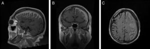 Brain MRI. (A) and (B) Coronal and sagittal T1-weighted sequences with gadolinium contrast showing enhancement of the left frontoparietal cortical sulci, subarachnoid space, and left subdural space. (C) Axial FLAIR sequence showing enhancement of the left frontoparietal cortical sulci, subarachnoid space, and left subdural space.