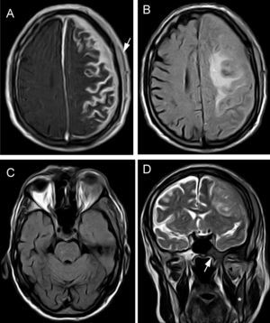 Brain MRI. (A) Axial T1-weighted sequence with magnetisation transfer contrast and gadolinum. Extensive leptomeningeal enhancement is seen in the left frontoparietal convexity, with dura mater thickening due to intradiploic involvement and epicranial soft tissue lesions (arrow). (B) FLAIR sequence: intraparenchymal vasogenic component of oedema in the left centrum semiovale. (C) Axial FLAIR sequence showing orbital mass affecting the left lacrimal gland and unilateral exophthalmos. D) Coronal T2-weighted TSE sequence: pathological hypointensity on the right side of the body of the sphenoid bone (arrow), base of the pterygoid process, and horizontal ramus of the mandible (asterisk). Signal changes were also seen in the lateral pterygoid muscle (arrowhead). The left side of the skull displays meningeal and epicranial infiltration.
