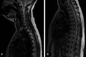 Gadolinium-enhanced sagittal T2-weighted MRI sequences of the cervical (A) and thoracic (B) spine, with normal results.