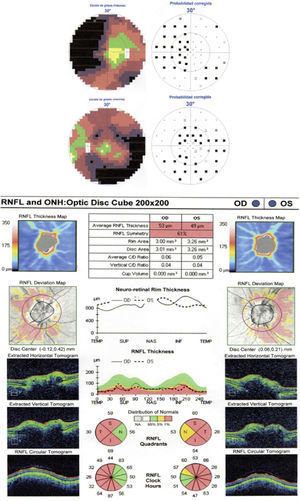 Bilateral nasal arcuate defects viewed using Octopus visual field analyser. ONT showed a decrease in the nerve fibre layer in the temporal, superior, and inferior regions of OU.
