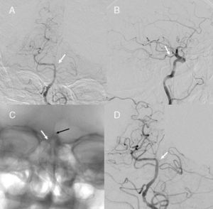 (A) Left atherosclerotic vertebral artery with occlusion of the left P1 segment (arrow). (B) Filling defect on the left posterior cerebral artery from the left posterior communicating artery. (C) Microguide wire inside the left P1 segment (black arrow) and microcatheter inside basilar artery (white arrow). (D) Recanalisation of the left P1 segment with filling of the artery of Percheron (arrow).