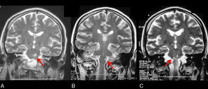 Cranial MRI, coronal T2-weighted sequences. (A) October 2006. Subacute left-sided lacunar pontine stroke (arrow). (B) September 2008. Subacute left-sided lacunar medullary stroke (arrow). (C) April 2011. Subacute right-sided lacunar pontine stroke (arrow).