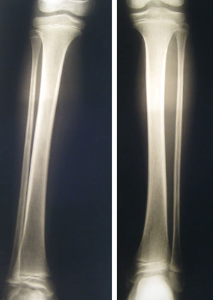 Decreased bone density in the right tibia