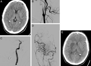 58-year-old man with dysarthria, left hemiparesis, and an NIHSS score of 14. (A) Cranial CT shows effacement of the lentiform nucleus and right insula; the patient scored 8 on ASPECTS. (B) The initial arteriography shows dissection of the right internal carotid artery, with typical flute-beak-shaped occlusion. (C) On the other side of the carotid occlusion, an occlusion was observed in the M1 segment of the right middle cerebral artery. (D) A mechanical thrombectomy was performed in the intracranial occlusion and a stent was placed in the carotid stenosis, achieving complete recanalisation as shown by the follow-up arteriography. (E) Follow-up cranial CT (at 24hours) displays infarction of the deep territory of the right middle cerebral artery.