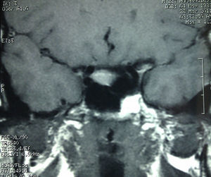 Sagittal section, MRI T1-weighted sequence before headache.