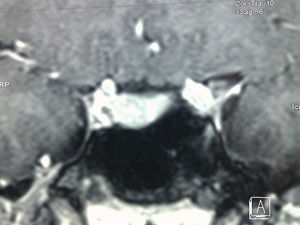 Sagittal section, T1-weighted MRI sequence with contrast after headache.