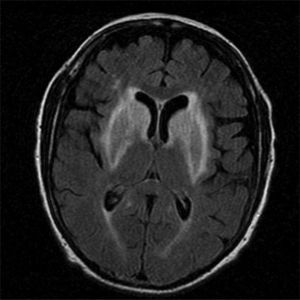 Brain MRI scan showing symmetrical anomalies in both striate nuclei and in the anterior limbs of the internal capsules with hyperintensities on FLAIR sequences.