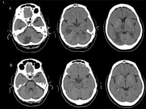 (A) A simple transverse CT scan performed 4 days after stroke displays multiple infarcts affecting the territory of both posterior cerebral arteries, right thalamus, and medial midbrain. (B) Simple transverse CT scan performed 18 days later showing apparent resolution of the lesions.