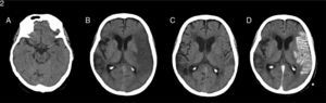 (A) A simple transverse CT scan performed when the patient arrived at the emergency department displays spontaneous hyperdense left MCA. (B) Simple transverse CT scan performed 24hours after stroke demonstrating an extensive hypodense area in the cortical-subcortical region affecting most of the territory of the left MCA, compatible with extensive subacute infarction in that area with a discrete mass effect on the left lateral ventricle. Malacia/gliosis can be observed in areas of the right hemisphere along the edge of old ischaemic lesions. (C) Simple transverse CT scan performed 10 days later showing less extensive hypoattenuated areas mainly affecting the peripheral territories, but also deep territories, in the corona radiata and left inner capsule. (D) A contrast CT scan was subsequently performed and showed pronounced gyriform cortical enhancement in the territory of the left MCA compatible with luxury perfusion in cortical and deep lesions secondary to subacute infarct.
