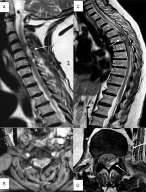 (A) Patient 4, sagittal section, T2-weighted TSE sequence. Epidural haematoma (arrow) in right posterior region located between segments C4 and C6 with a compressive effect on the spinal cord that causes myelopathy. (B) Patient 4, axial section at C4, T2*-weighted GE sequence. A haematoma can be seen in the right posterior region (arrow). (C) Patient 1, sagittal section, T2-weighted TSE sequence. Predominantly anterior epidural haematoma (arrow) between segments T6 and L2, causing medullary compression and associated signs of myelopathy. (D) Patient 11, axial section at level of T12-L1, T2-weighted TSE sequence. Epidural haematoma (arrow) in the lateral posterior region, displacing and compressing the thecal sac.