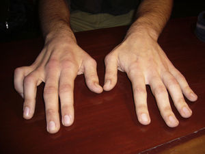 Patient 1. Amyotrophy of the dorsal interosseous muscles of the right hand and the beginnings of ulnar claw.
